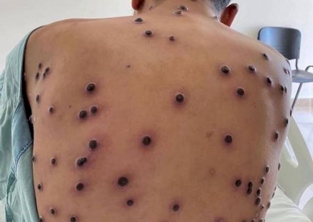 Brasil registra 88 casos de Mpox em 2026; saiba como evitar a doença